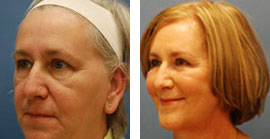 facelift results in fairfax, virginia