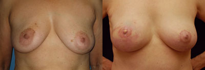 Breast Reconstruction Patient