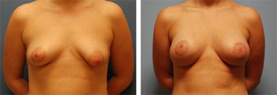 bilateral breast augmentation with left breast mastopexy