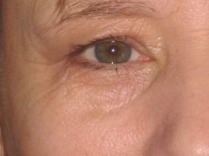 aging-eyes-21