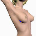 breast incision cartoon