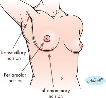 breast augmentation incisions