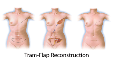 tram flap reconstruction