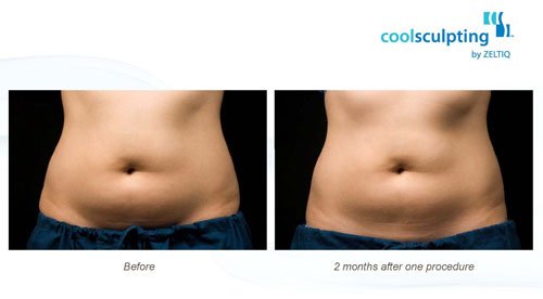 Coolsculpting Before and After Results From Actual Patients