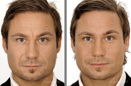 before-after-restylane-man
