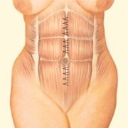 Abdominal Muscle Repair