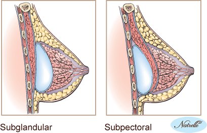 implant placement