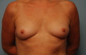 Breast Surgery Breast Augmentation