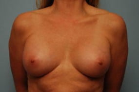 Breast Surgery Breast Augmentation