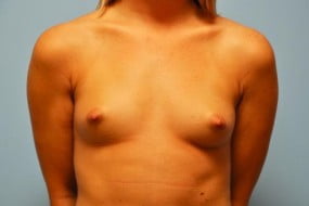 Breast Surgery Breast Augmentation