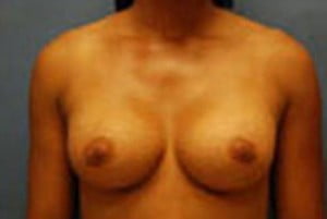 Breast Surgery Breast Augmentation