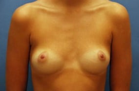 Breast Surgery Breast Augmentation