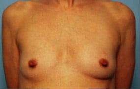 Breast Surgery Breast Augmentation