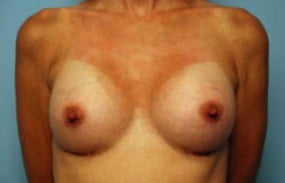 Breast Surgery Breast Augmentation