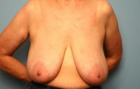 Breast Surgery Breast Lift with Augmentation