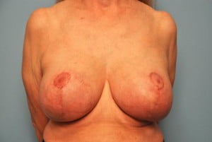 Breast Surgery Breast Lift with Augmentation