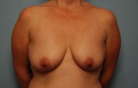 Breast Surgery Breast Lift with Augmentation