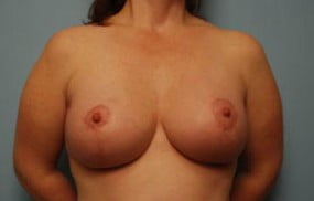 Breast Surgery Breast Lift with Augmentation