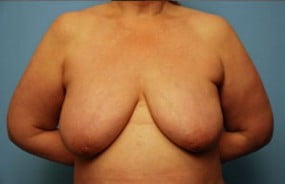 Breast Surgery Breast Lift