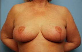 Breast Surgery Breast Lift