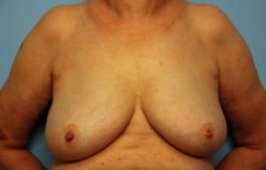 Breast Surgery Breast Lift