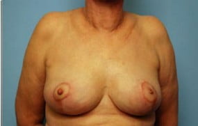 Breast Surgery Breast Lift