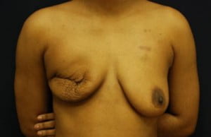 Breast Reconstruction