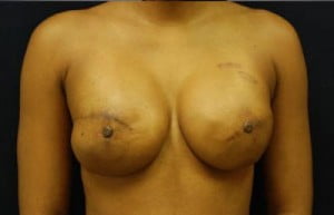 Breast Reconstruction