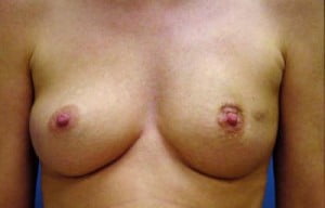 Breast Reconstruction