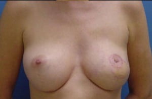 Breast Reconstruction