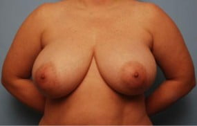 Breast Surgery Breast Reduction