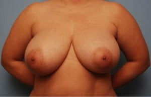 Breast Surgery Breast Reduction