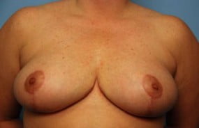 Breast Surgery Breast Reduction