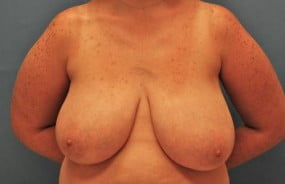 Breast Surgery Breast Reduction