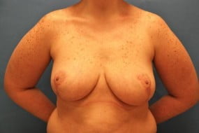 Breast Surgery Breast Reduction