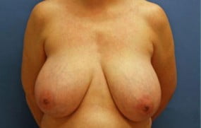 Breast Surgery Breast Reduction