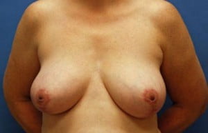 Breast Surgery Breast Reduction