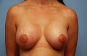 Breast Surgery Breast Lift with Augmentation