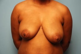 Breast Surgery Breast Asymmetry Correction