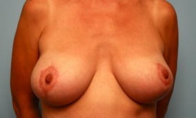 Breast Surgery Breast Lift with Augmentation