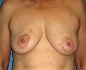 Breast Reconstruction