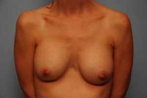 Breast Surgery Breast Augmentation