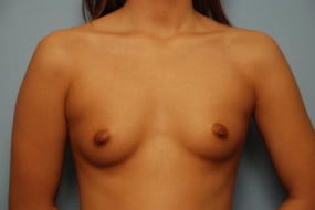 Breast Surgery Breast Augmentation