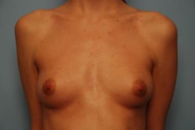 Breast Surgery Breast Augmentation