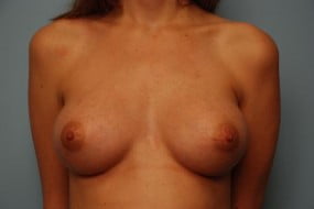 Breast Surgery Breast Augmentation