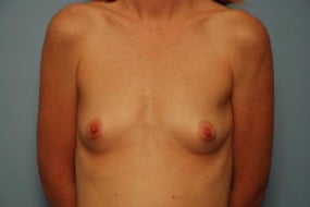 Breast Surgery Breast Augmentation