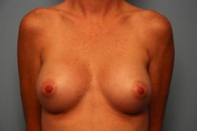 Breast Surgery Breast Augmentation