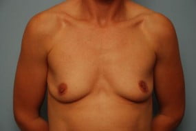 Breast Surgery Breast Augmentation