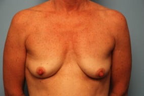 Breast Surgery Breast Lift with Augmentation