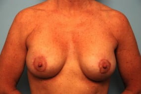 Breast Surgery Breast Lift with Augmentation